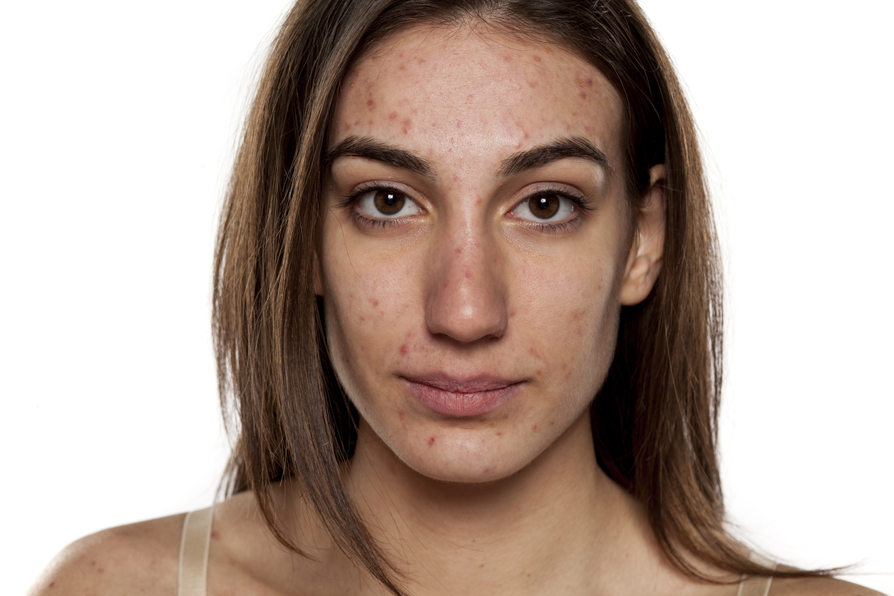 VD 57 : FMC 77 : Acné et hormones – acné de la femme adulte isotretinoine versus spironolactone