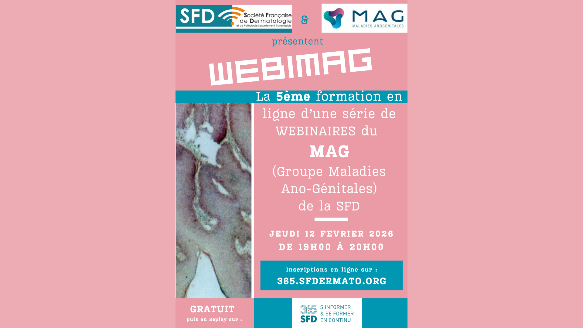 5ème webinaire du Groupe Maladies Ano-Génitales (MAG) de la SFD